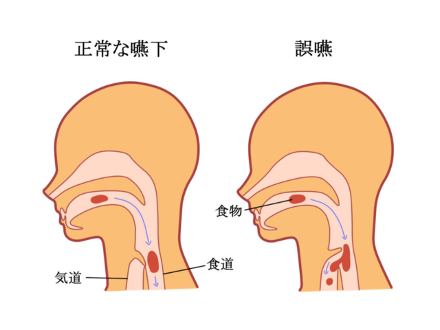 摂食障害：なぜ受診が遅れるのか２